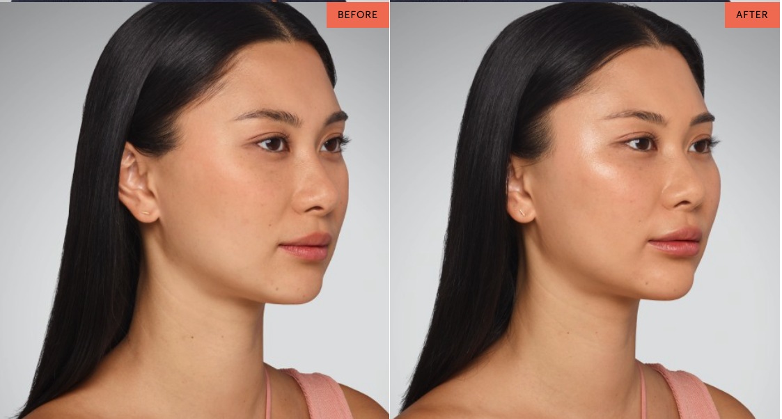 GamWellness - DermalFillers1