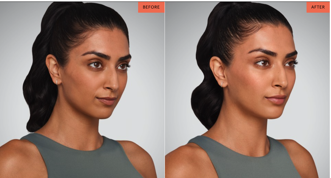 GamWellness - DermalFillers2