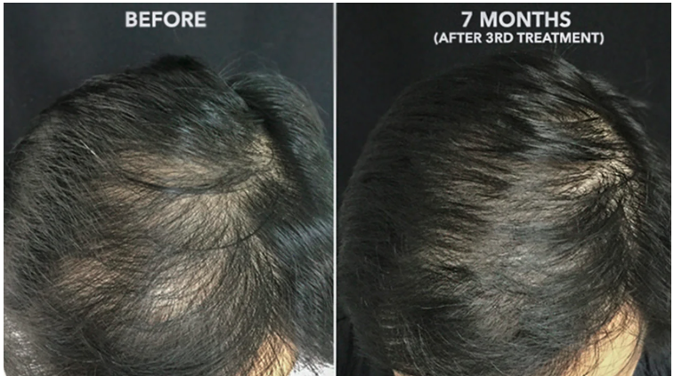 GamWellness - HairRestoration2