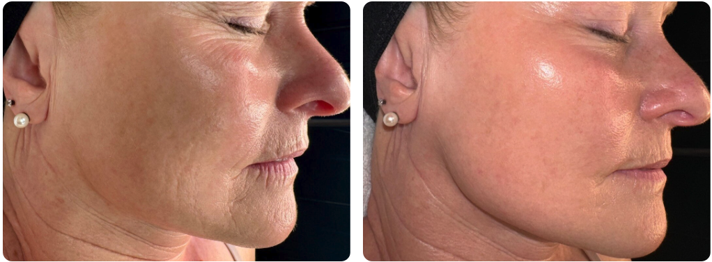 GamWellness - Microneedling1