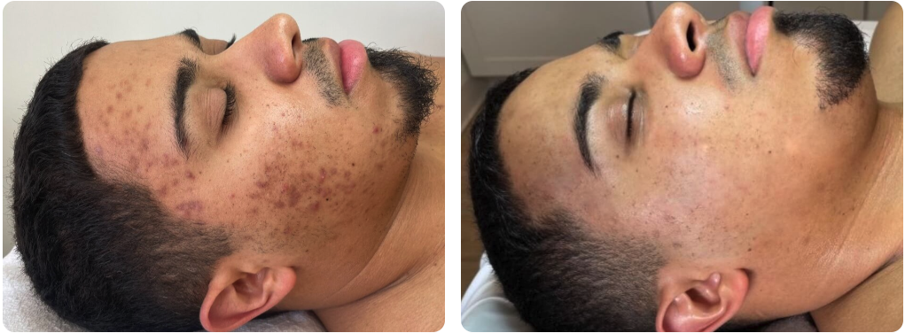 GamWellness - Microneedling2