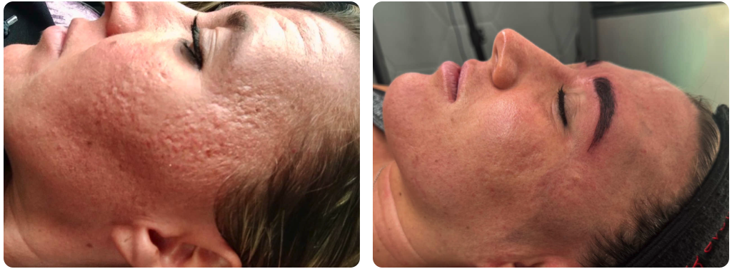GamWellness - Microneedling3