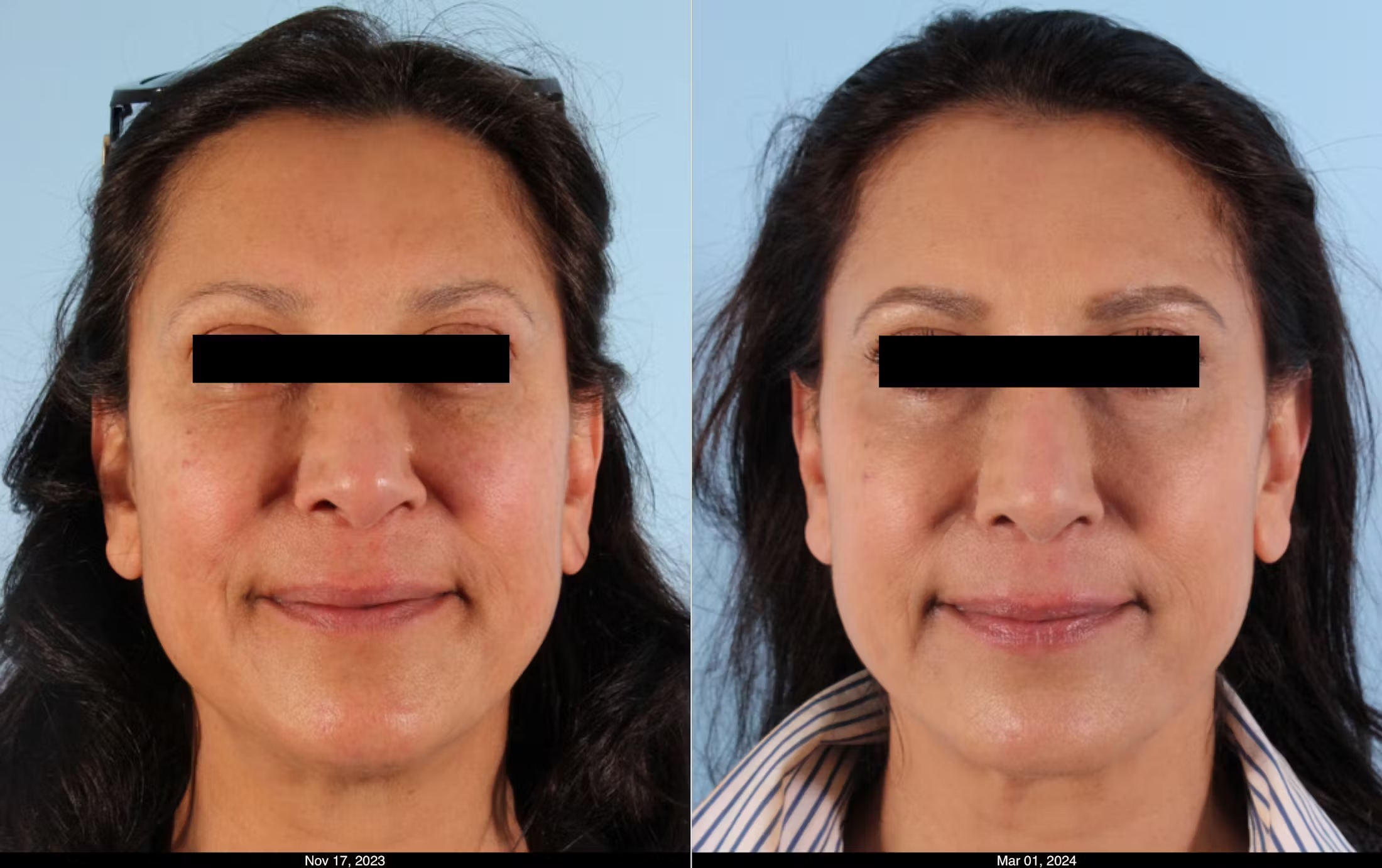 GamWellness - Scarlet Microneedling Before and After1