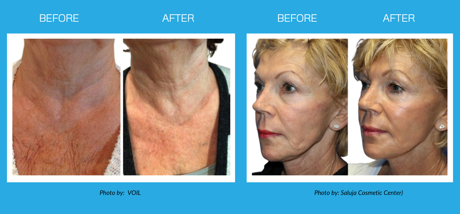 GamWellness - Scarlet Microneedling Before and After2