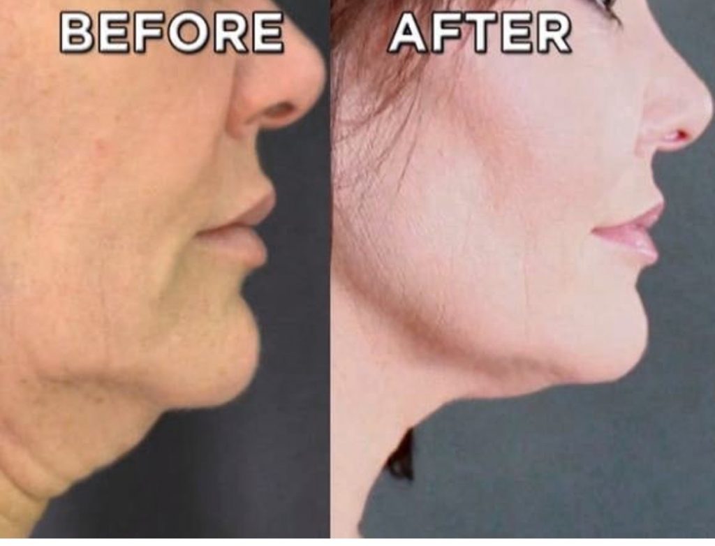 GamWellness - Scarlet Microneedling Before and After3