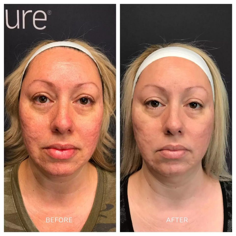 GamWellness - Scarlet Microneedling Before and After4